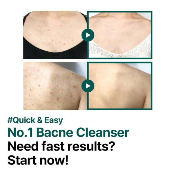 SOME BY MI, CLEAR BODY CLEANSER, აკნეს სამკურნალო შხაპის გელი, 400 G - Image 3